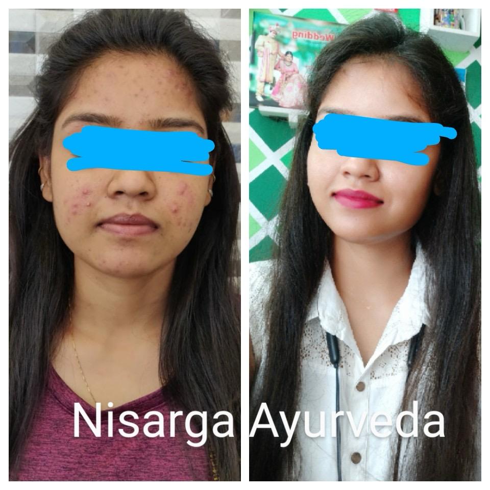 Ayurvedic Acne | Pimple | Skin Infection Clearing | Dark Spot Removal Face Pack-100gm