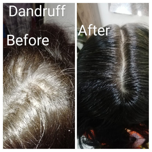 Anti-Dandruff Hair Pack Powder for Itchy, Scaly Scalp | Fights Infections, Pollution & Sweat-100gm