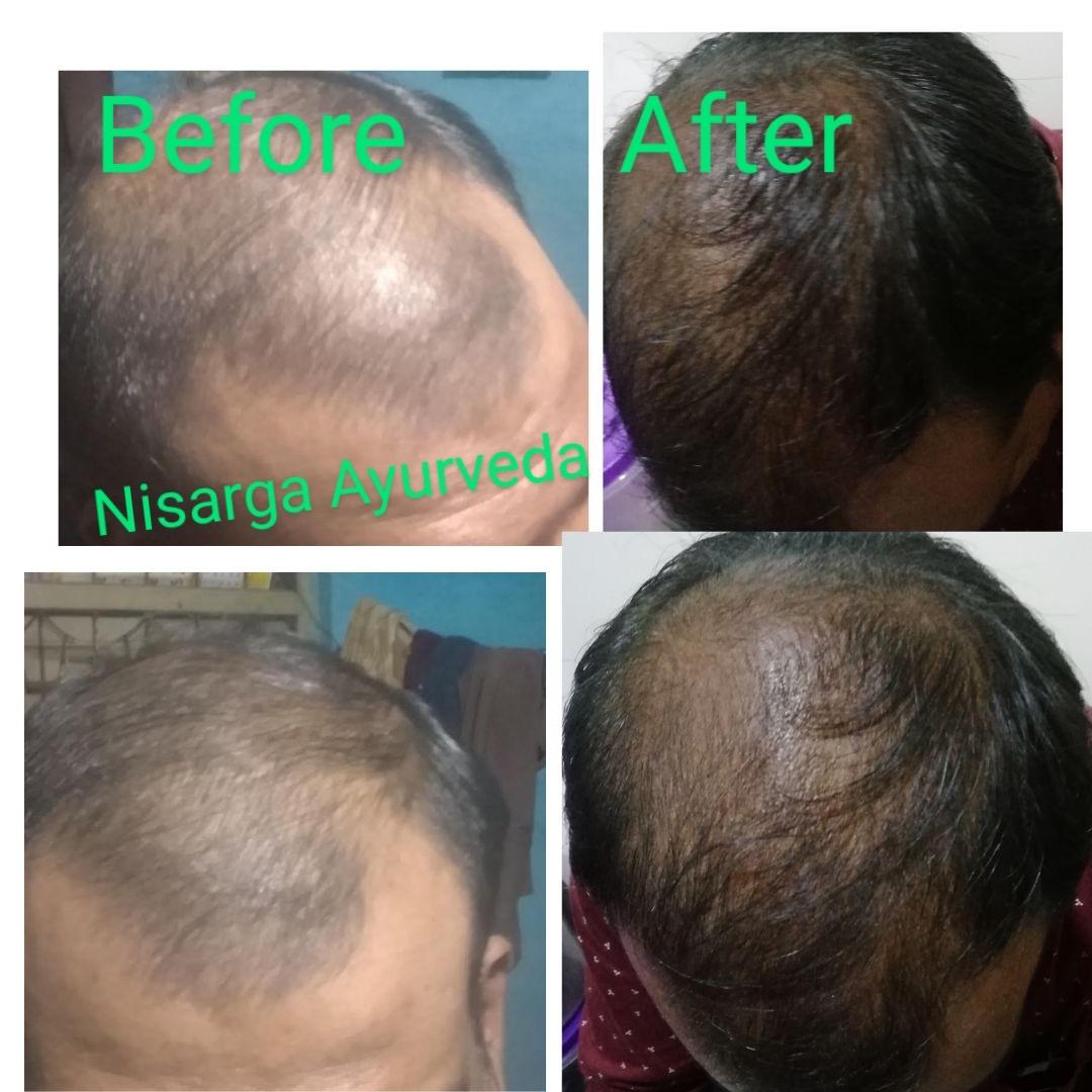 Ayurvedic Hair Oil for Hair Fall control | Hair Nourishment for Men and Women-100ml